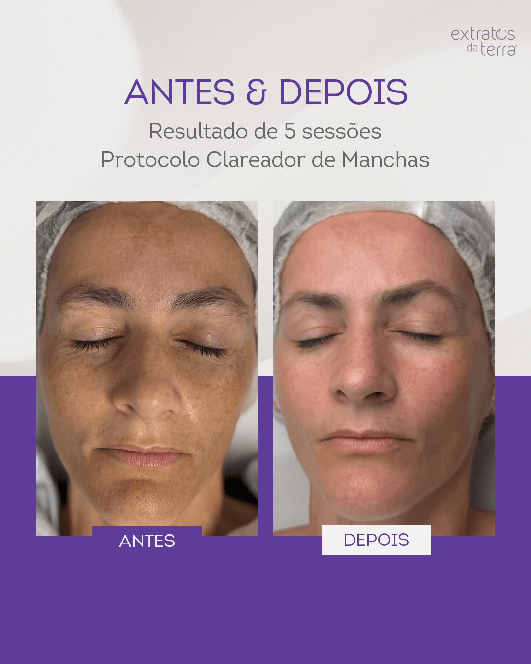 Kit Clareador de manchas e melasma com Exossomos Profissional