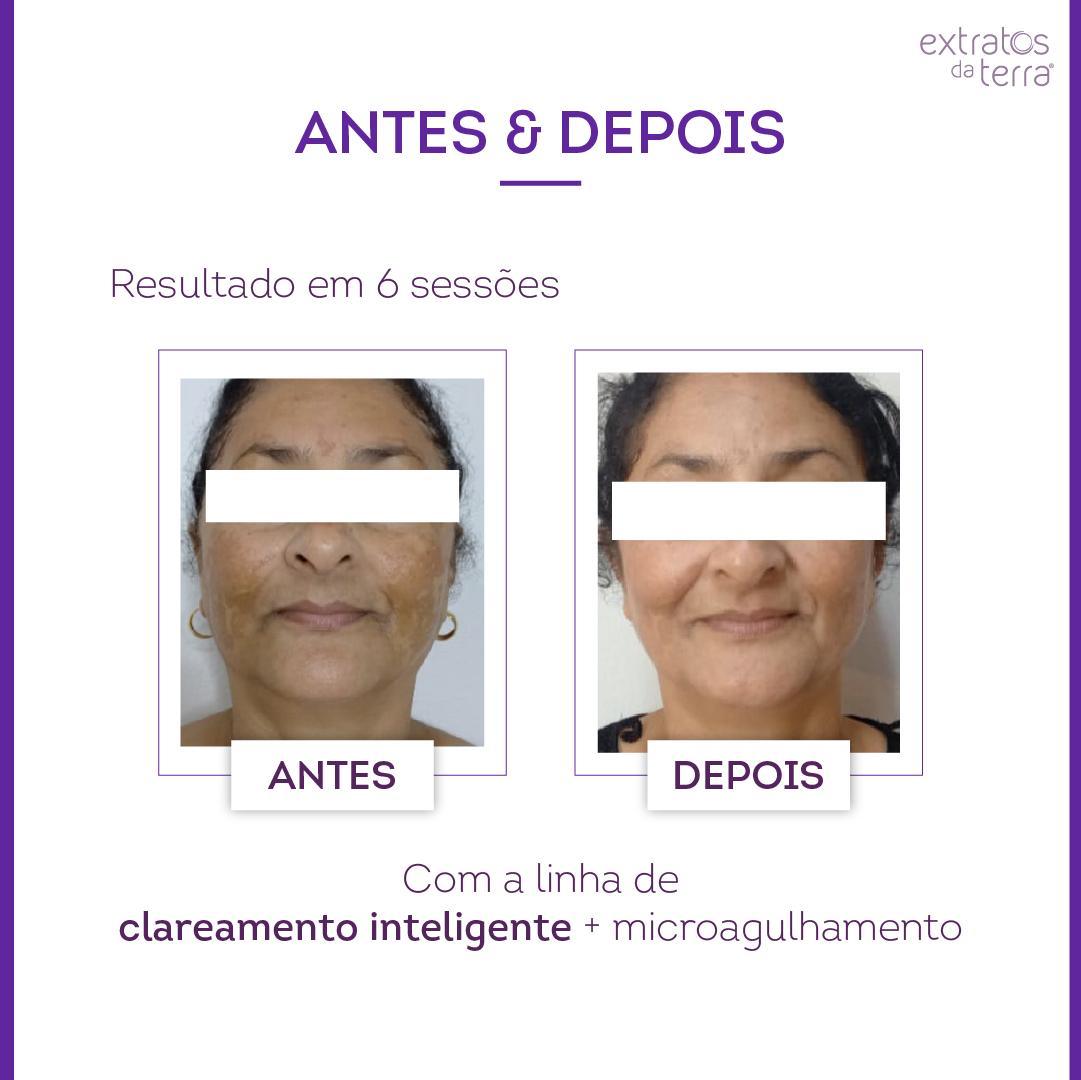 Kit Clareador de manchas e melasma com Exossomos Profissional - Imagem da Maleta Ilustrativa, kit não inclui