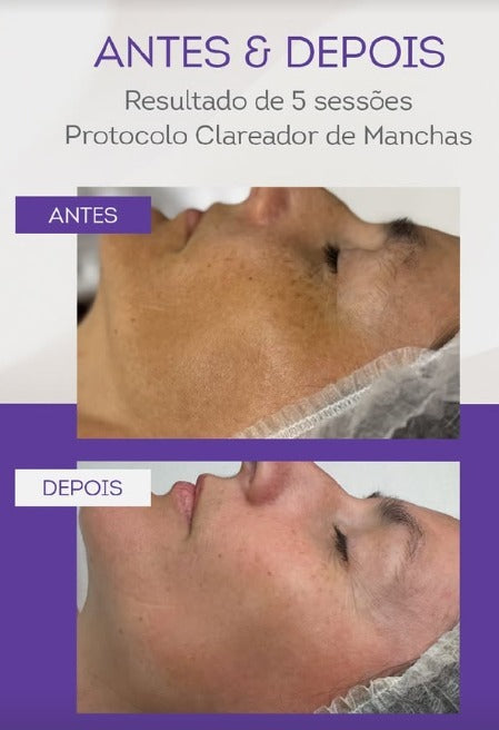 Kit Clareador de manchas e melasma com Exossomos Profissional - Imagem da Maleta Ilustrativa, kit não inclui
