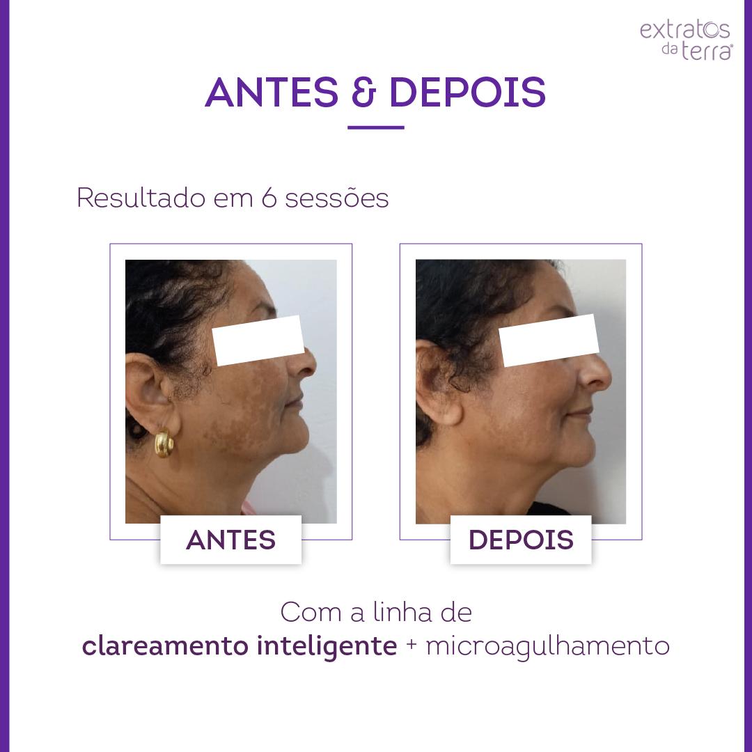 Kit Clareador de manchas e melasma com Exossomos Profissional - Imagem da Maleta Ilustrativa, kit não inclui